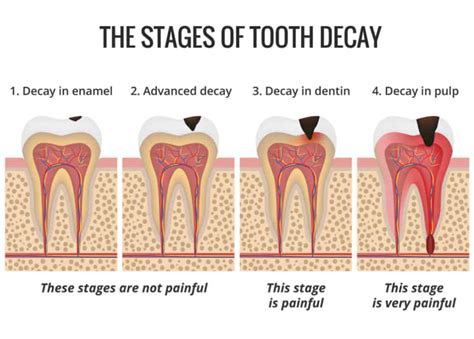 cavity goon|cavities on teeth.